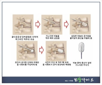 압박골절로 활동량 줄면 우울증 위험, 조기치료가 필수!