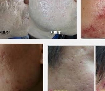부산여드름흉터 남아있다면