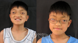 희귀병 앓는 임재성.재빈 형제