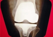 희명병원, 다양한 인공관절 수술 실시