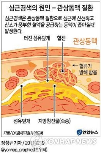 김정일, 중증급성 심근경색과 심장쇼크로 사망