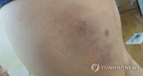 허벅지에 든 멍자국