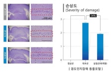 치매 전 단계 경도인지장애 침으로 고친다