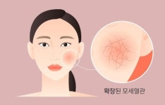 갱년기 질환 안면홍조…젊은 여성과 남성도 겪는다