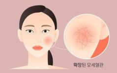 안면홍조 고통, 비만 여성이 더 심하다