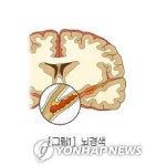 뇌졸중 생존자, 1년 내 우울증 위험↑