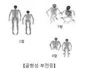 뼈 쉽게 부러지는 골형성부전증 치료 연구 심의 통과