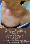 [제보] “6살 아이 손톱으로 쥐어 뜯겨...” 포항 A 어린이집 학대 ‘충격’