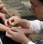 무료진료후 침술 봉사하는 이구형원장