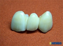 치과 ‘생체세라믹’ 국산화‥보급활발