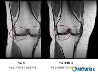 무릎연골 파열, 4~6주면 고통 사라진다