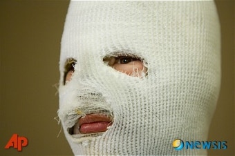 얼굴 예뻐 당한 염산테러, 사실은 자작극