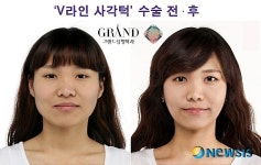 각진 사각턱, V라인 얼굴 되기 위한 생활 Tip