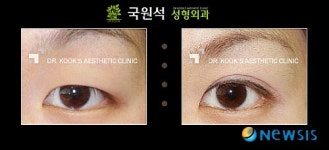 성형외과 전문의에게 듣는 쌍꺼풀 수술 잘하는 방법
