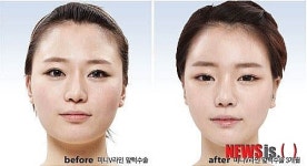 V라인사각턱수술, 뭉툭한 앞턱 가진 환자에게 적합
