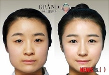 사각턱 부르는 잘못된 생활습관, V라인 얼굴 망친다?