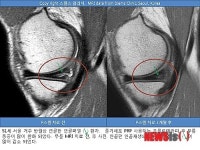 무릎 반월상 연골판 연골 절제? 한번더 알아보세요