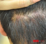 지루성두피염·피부염, 한방치료를 선호하는 까닭은?