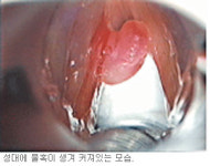 성대종양 레이저로 싹！…목소리도 수술후 개선