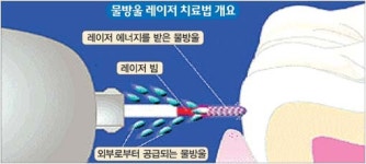 치과 치료 물방울 레이저 시술법 뜬다… 잇몸 절개 출혈 거의 없어