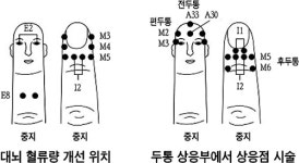 고려수지요법, 만성 두통에 90% 개선 효과… 부산대 박규현 교수팀 임상연구