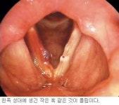 목소리 커진 주부들?… ‘성대 폴립’ 발병 33.5%로 최다