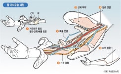 이라크 근무중 팔·다리 잃은 美 26세 전역병, 두 팔 이식 수술… 기적의 새 삶 찾았다
