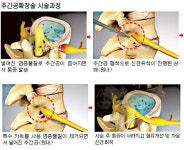광혜병원, 추간공확장술로 깊숙히 뚫어 척추 통증 해결