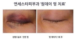멍 빨리 없애는 법, ‘원데이 멍 치료’ 하루면 말끔