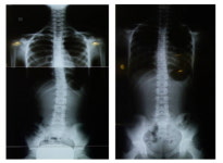 방치하면 더 악화되는 척추측만증, 정확한 치료방법은?