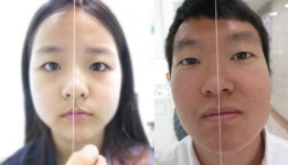 안면비대칭과 입꼬리비대칭, 턱관절치료로 재발없이 건강하게