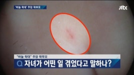 ‘바늘 학대사건’ 남양주 어린이집 교사 무죄… 왜?