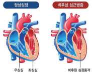 “급사 초래 비후성 심근증, 일반인 환자는 적정한 운동 해도 괜찮다”