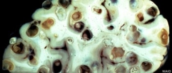 돼지고기 덜 익혀 먹으면..기생충 감염 뇌 사진 충격