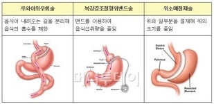키 늘리고 머리 심고…컴플렉스 수술의 모든 것