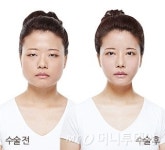 퀵안면윤곽수술, 안전하고 완벽하게