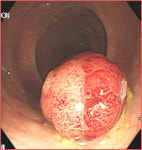 대장 내시경은 5년에 한 번?…이럴 땐 내년에 또 받아야