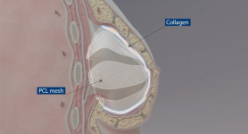 플코스킨, PCL-콜라겐 하이브리드 시트의 개발연구 스케일업 팁스(TIPS) 선정
