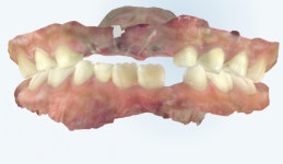 와자작 부럼 깨다 우리 아이 유치 쏙…영구치 나잖아 방심했다간