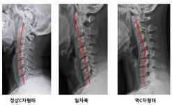 일자목증후군보다 무서운 공룡목증후군