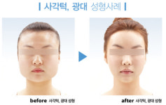 안면윤곽수술로 얼큰녀, 큰바위얼굴 졸업한다