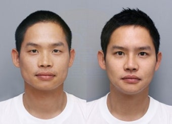 개그맨 김형인, 성형수술 결심한 이유는?