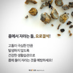 출산만큼 아프다는 요로결석, 방지하려면 이렇게