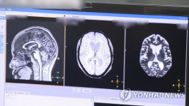 뇌·혈관 MRI 검사비 낮아진다…9월부터 건강보험 적용