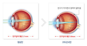 청소년 근시 발병률↑…망막박리·녹내장 주의해야