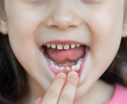 우리 아이 유치 발치 어떻게