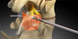 서울 광혜병원, 추간공확장술 예후 높이기 위해 시술 후 면역관리가 중요한 이유