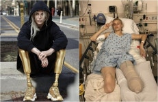 탐폰 썼다가 두다리 잃은 모델…‘독성쇼크증후군’ 뭐길래