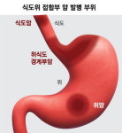 늘어나는 식도위 접합부 암 비만·역류성 식도염이 주범