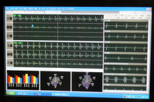 디지털 방식 맥진기 개발